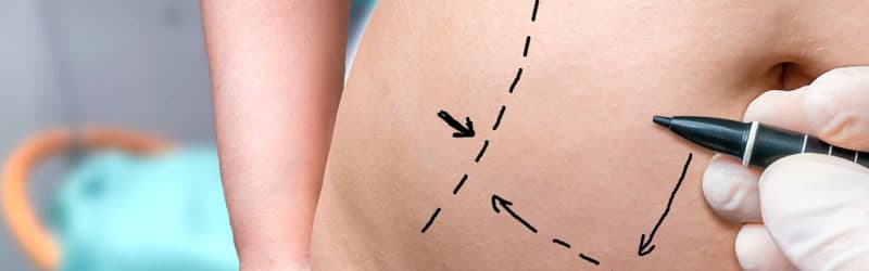 O que saber antes de fazer uma abdominoplastia?